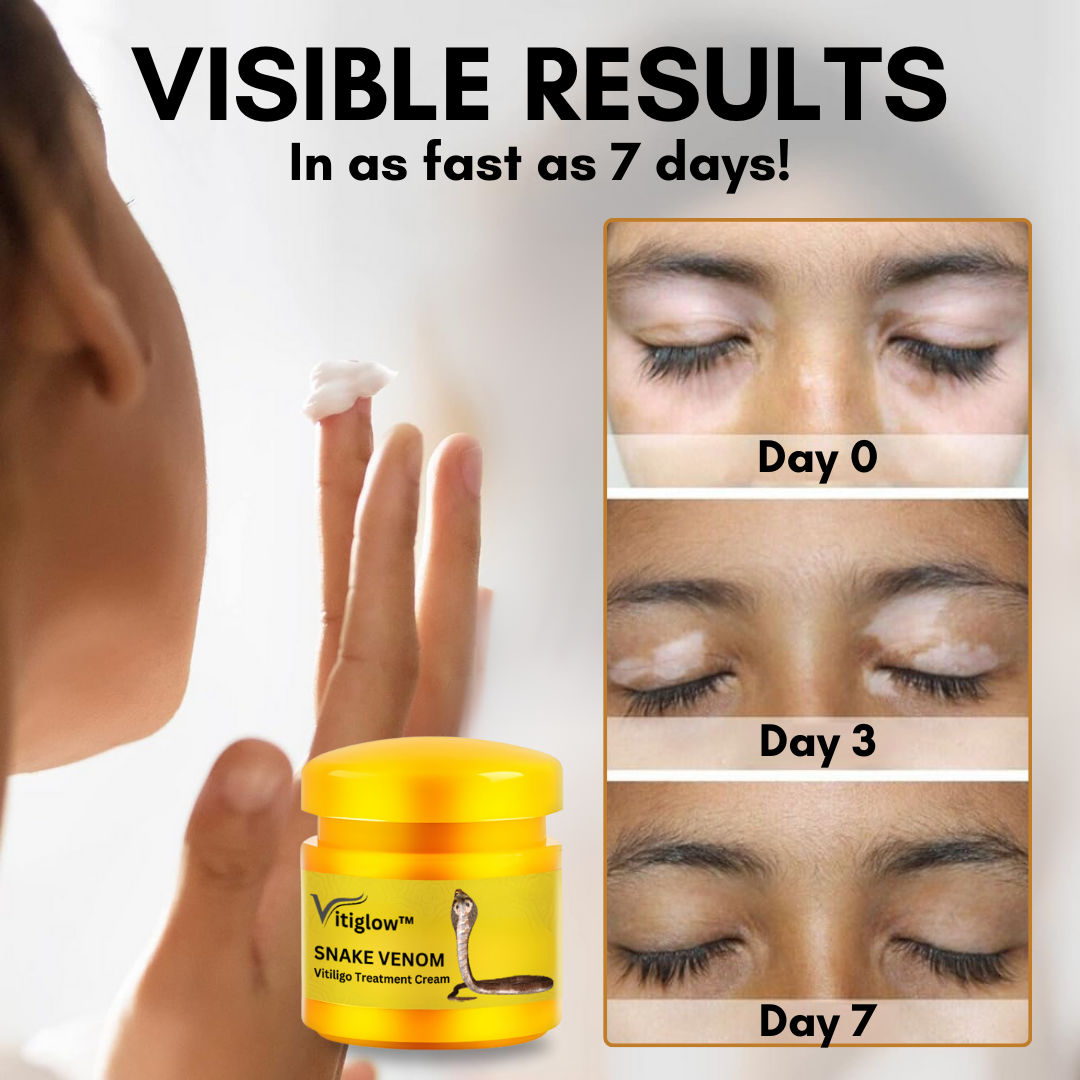 Vitiglow™ Snake Venom Vitiligo Treatment Cream - 👩⚕️ Recommended by Experts! 🔥 30-Days Money-Back Guarantee! 💰