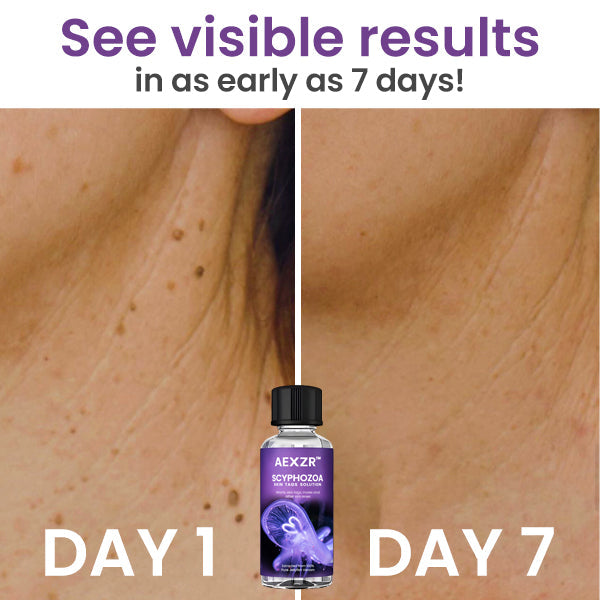 AEXZR™ Scyphozoa Skin Tags Solution - 👩⚕️ Recommended by Experts 💥 80% Limited Discounts 🎉