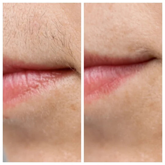 BQYOOM™ PCOS Facial Hair Natural Treatment At Home