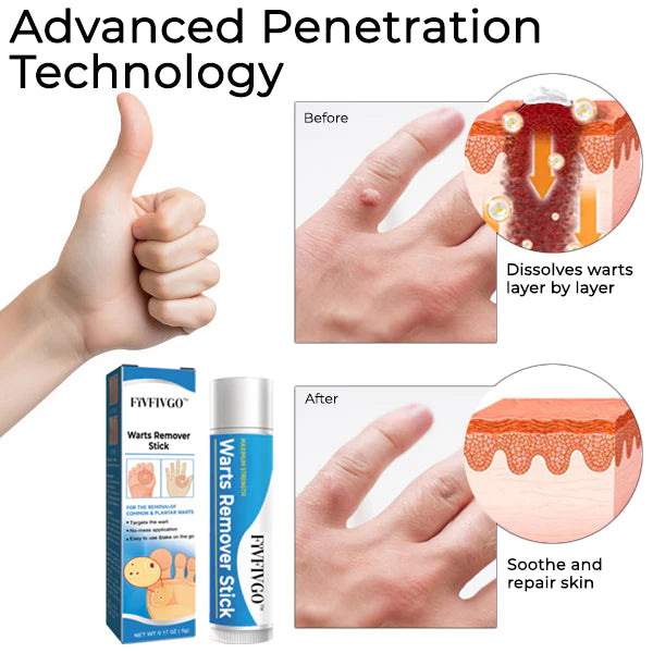 Fivfivgo® Warts Remover Stick