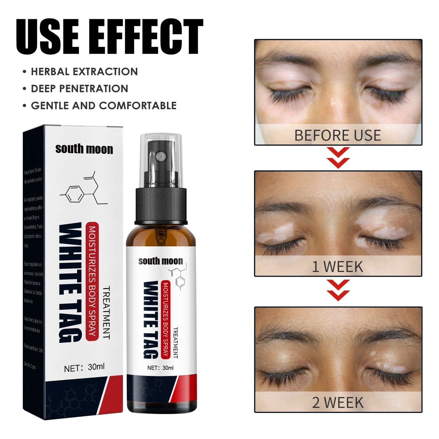 đĽHot Sale - 49% OFFđ South Moon Vitiligo Relief Spray