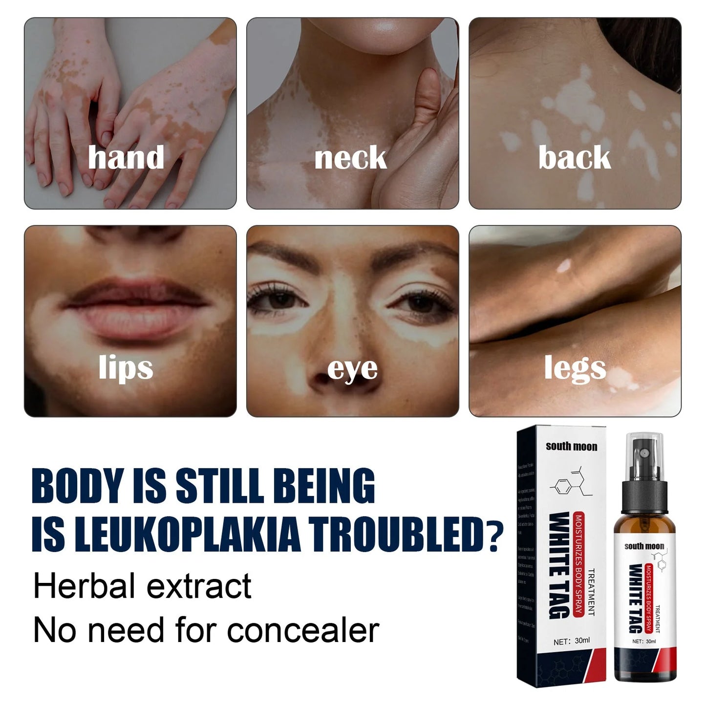 đĽHot Sale - 49% OFFđ South Moon Vitiligo Relief Spray