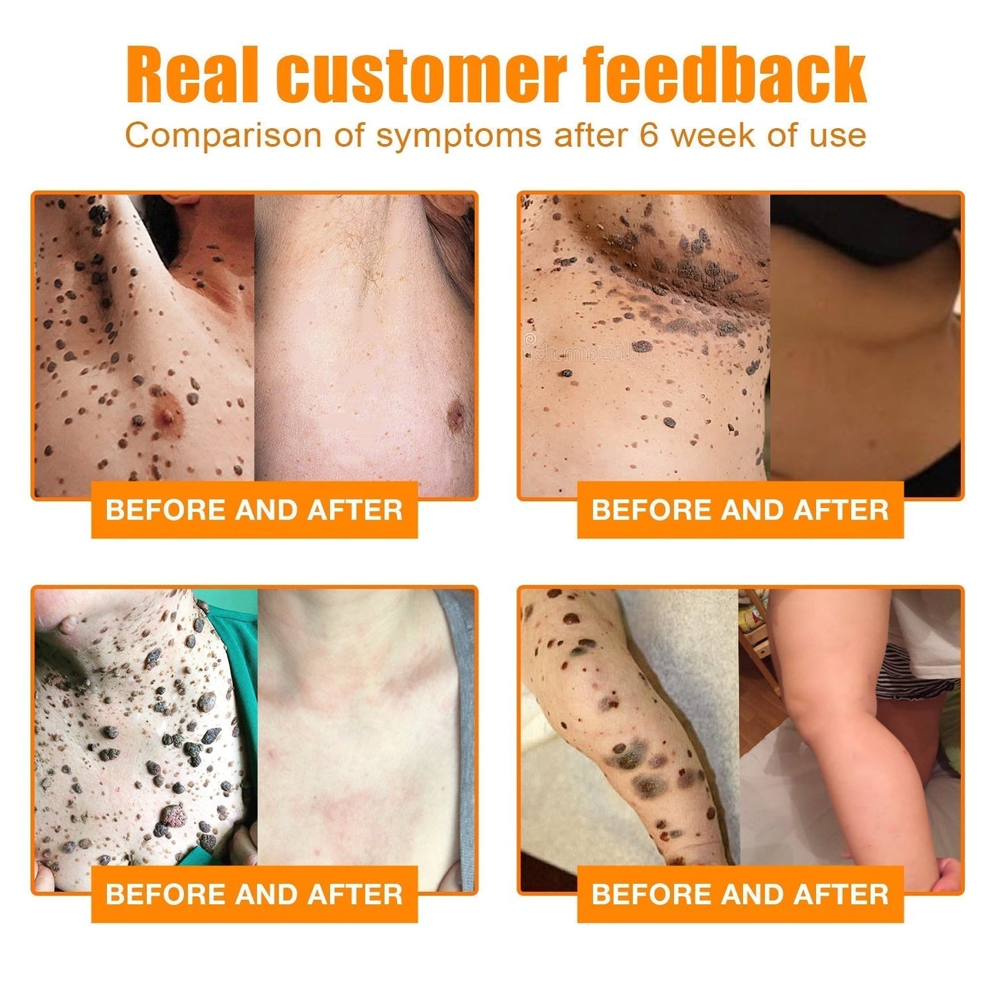 šLOVILDS⢠Bee Venom Wart & Tag Removal Cream(šØāāSuitable for all skin types)š(š„BUY 1 GET 1)