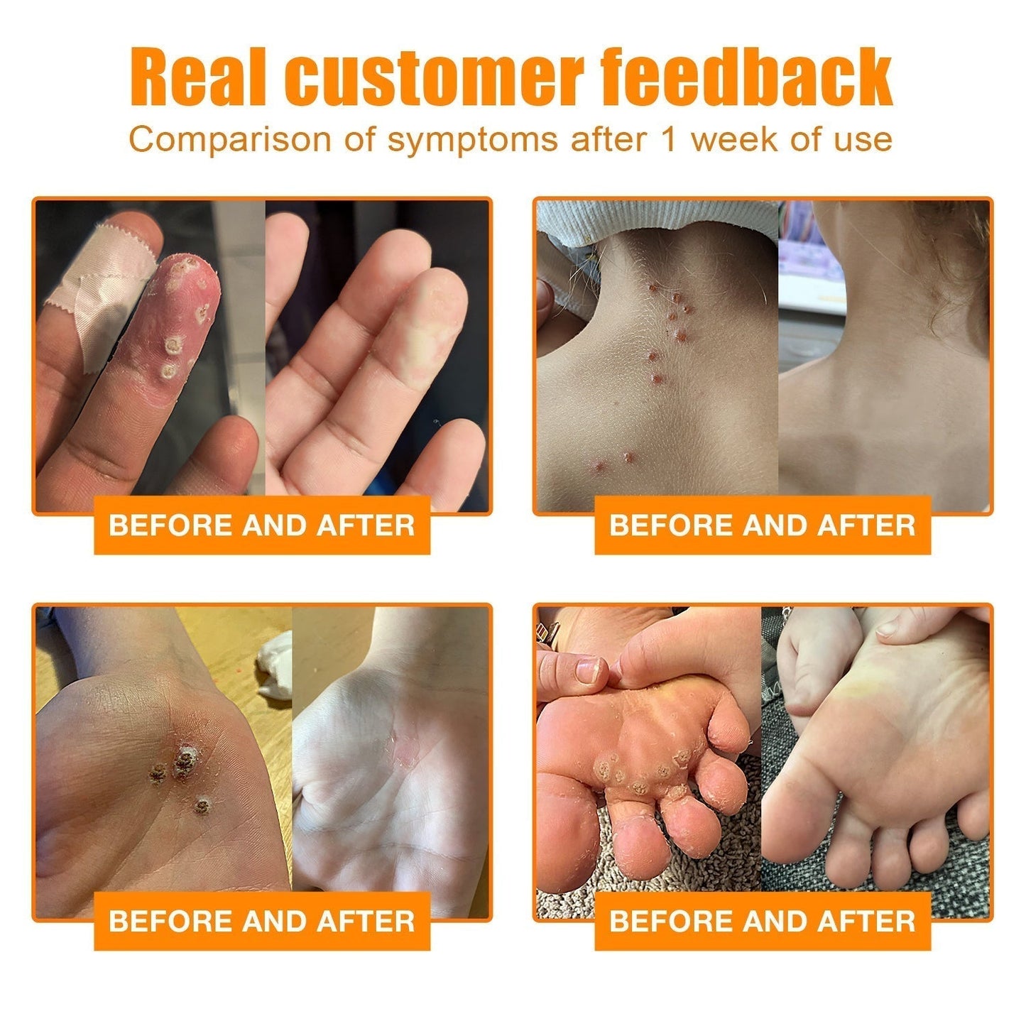 šLOVILDS⢠Bee Venom Wart & Tag Removal Cream(šØāāSuitable for all skin types)š(š„BUY 1 GET 1)