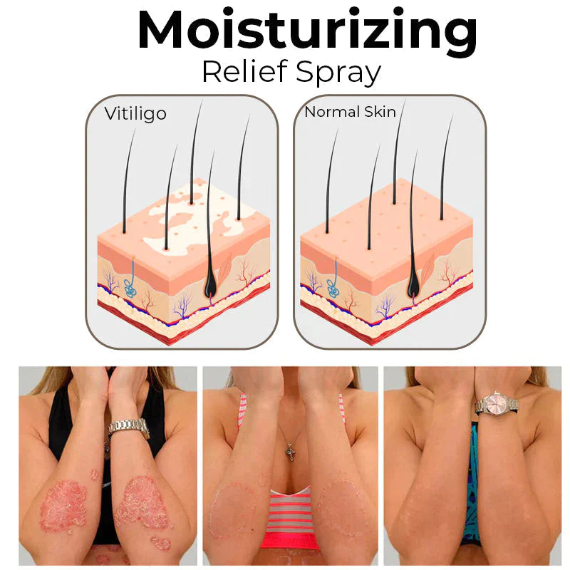 đĽHot Sale - 49% OFFđ South Moon Vitiligo Relief Spray