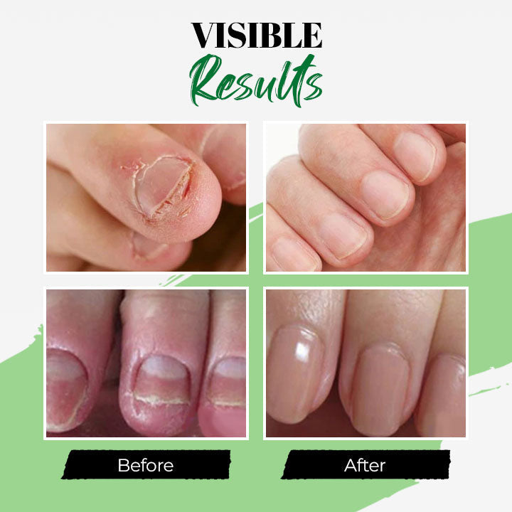 Fungal Nail Treatment Essential Oil