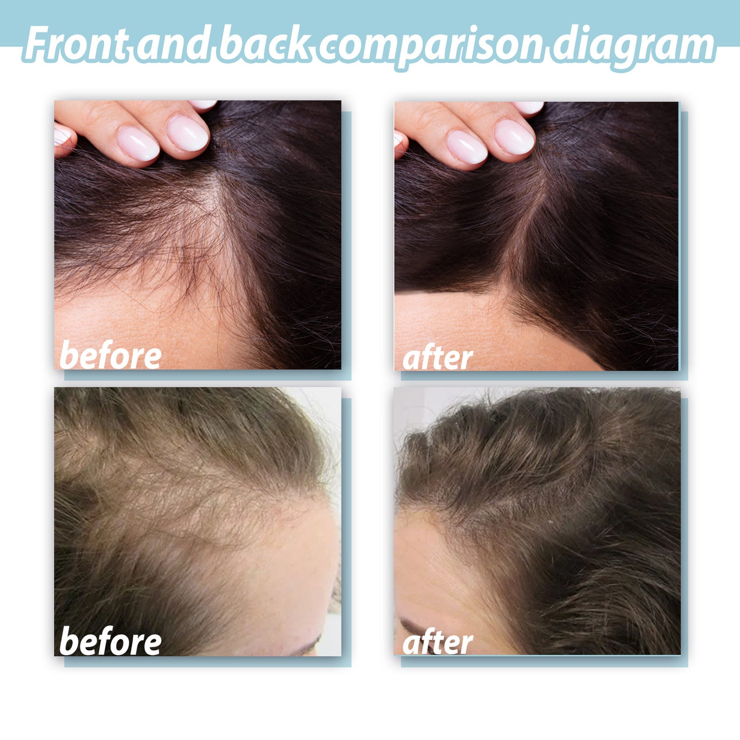 Get extra 50% off now! Through trichologist test, 3-4 PCS will completely Regrow your hair and will never fall off again.