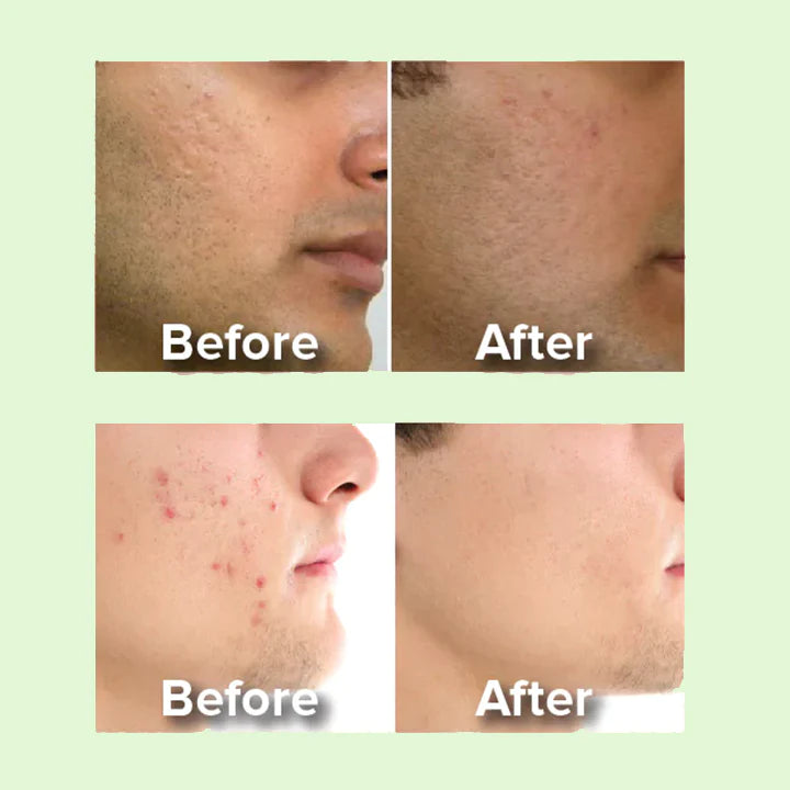 BioLap™ Aloe Vera Acne Serum Gel