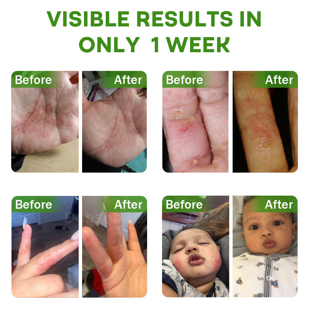 Piguiay® Herbal Psoriasis Relief Cream