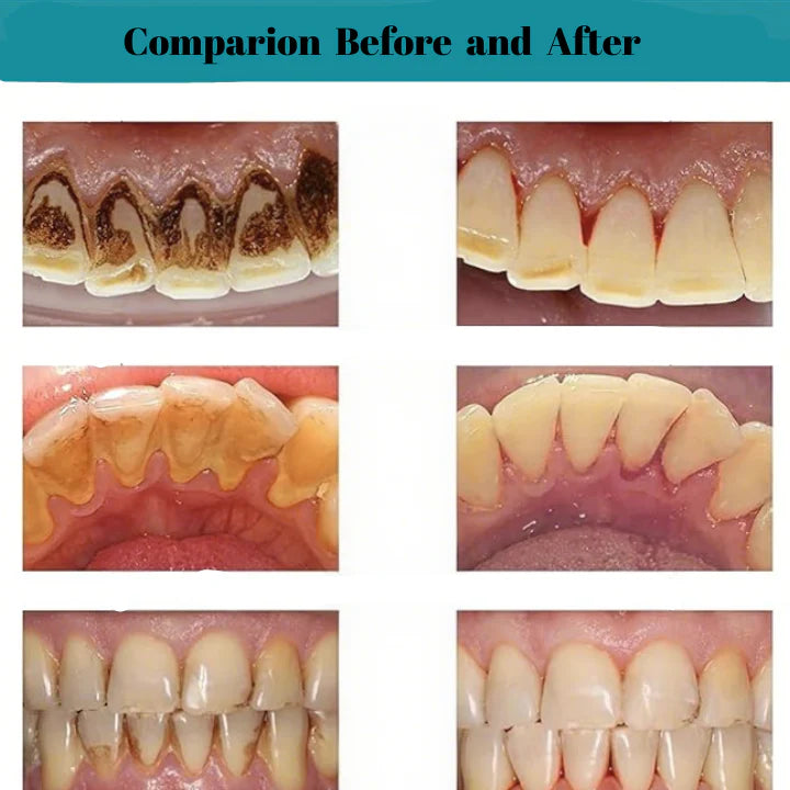 AEXZR® Oral Calculus Suppressant✨𝗙𝗶𝗴𝗵𝘁 𝗧𝗮𝗿𝘁𝗮𝗿 𝗘𝗳𝗳𝗲𝗰𝘁𝗶𝘃𝗲𝗹𝘆!✨