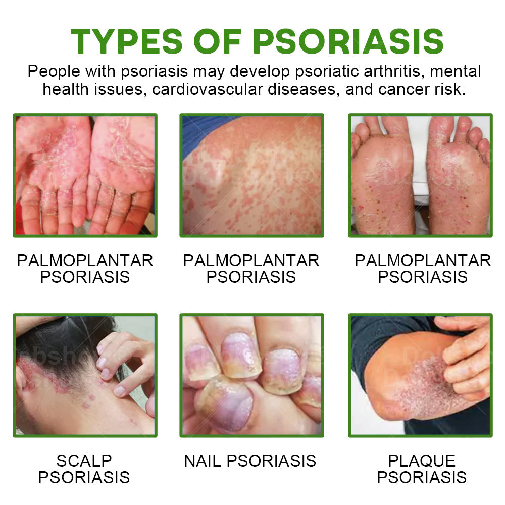 Piguiay® Herbal Psoriasis Relief Cream