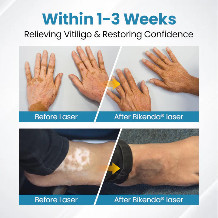 Nurbini®DermaBeam Vitiligo Therapy Device