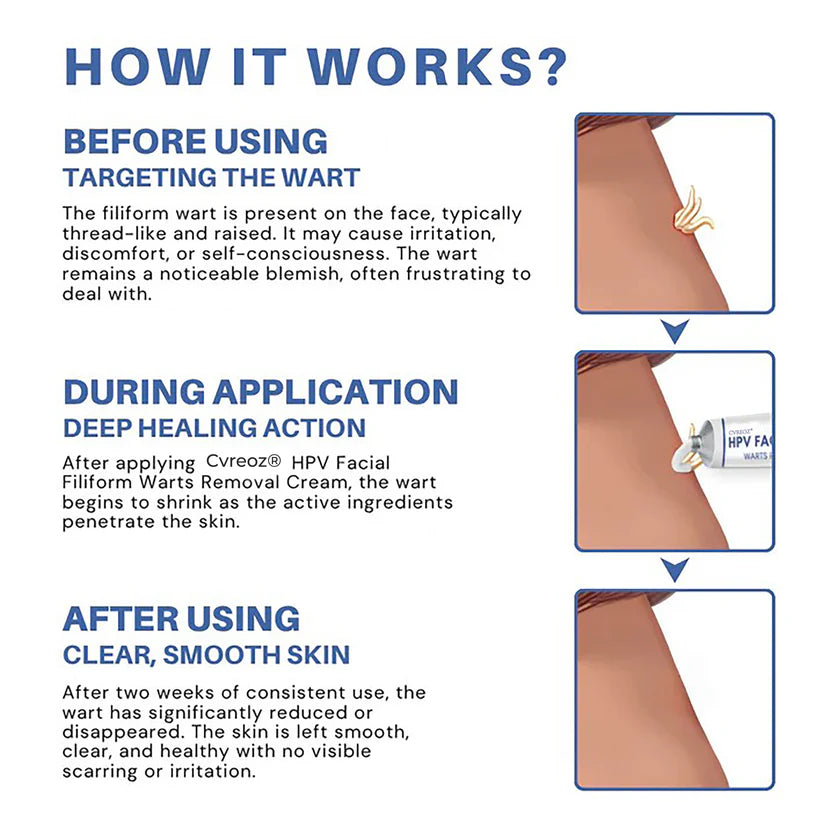 Cvreoz® HPV Facial Filiform Warts Removal Cream