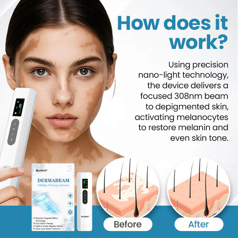 Nurbini®DermaBeam Vitiligo Therapy Device
