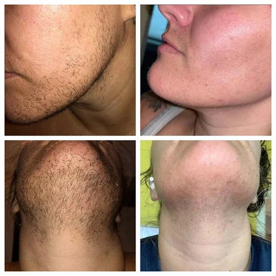 BQYOOM™ PCOS Facial Hair Natural Treatment At Home