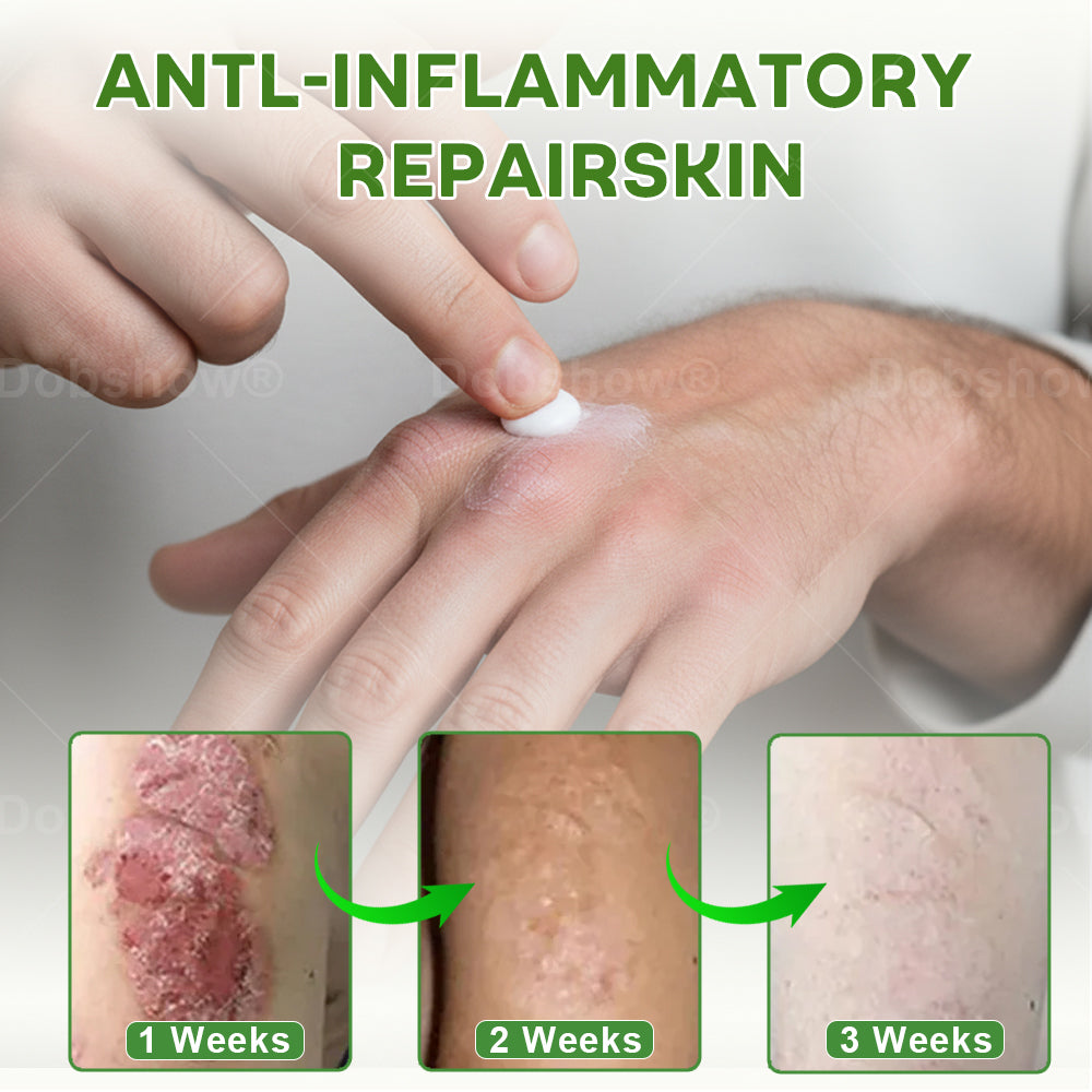 Piguiay® Herbal Psoriasis Relief Cream