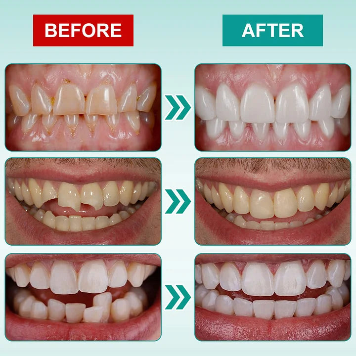 🧑‍⚕️🦷 YUNPSO™ Instant Stick-On Dental Veneers
