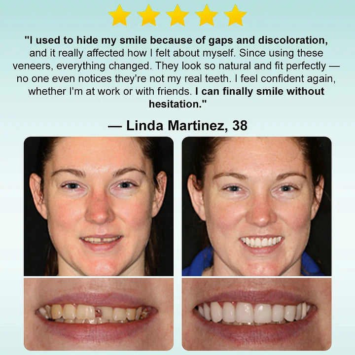 🧑‍⚕️🦷 YUNPSO™ Instant Stick-On Dental Veneers