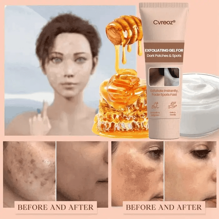 Cvreoz® Purifying Exfoliating Gel for Acanthosis Nigricans, Exfoliation, Dark Spots, Skin Tags, and Eczema