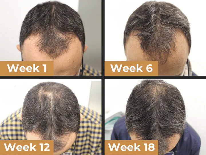 Easter Sale Countdown!⏰DIYSTAR™Root Activator Shampoo- Regain a full head of hair in just 4 weeks!