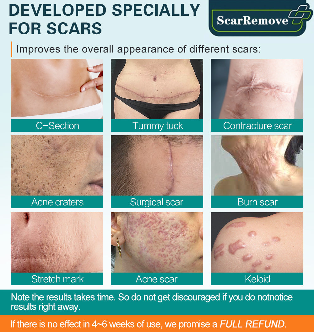 ❤️South Moon™ Advanced Scar Spray For All Types of Scars - Especially Acne Scars, Surgical Scars and Stretch Marks