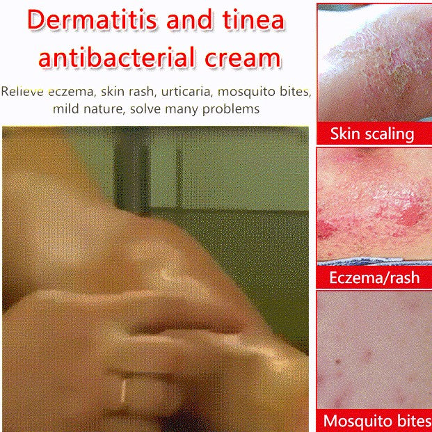 Dermatitis and Tinea Antibacterial Psoriasis Cream