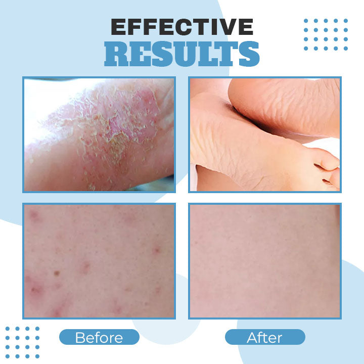 Organic Eczema Relief Repair Cream