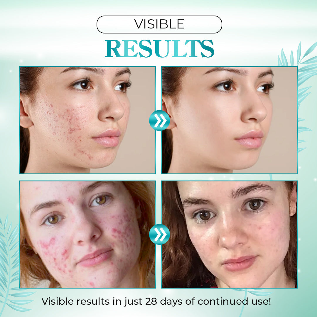 AUQUEST Salicylic Acid Acne Treatment Cream