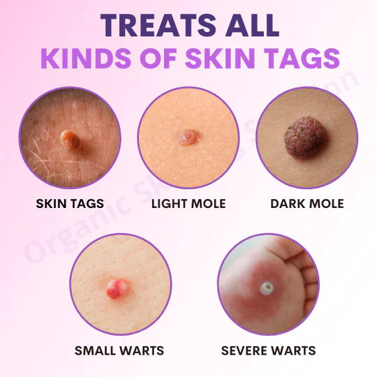 GoldenTime™ Organic SkinTag Solution