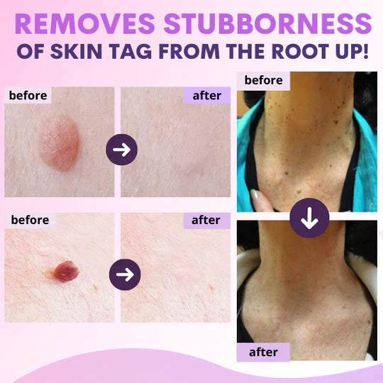 GoldenTime™ Organic SkinTag Solution