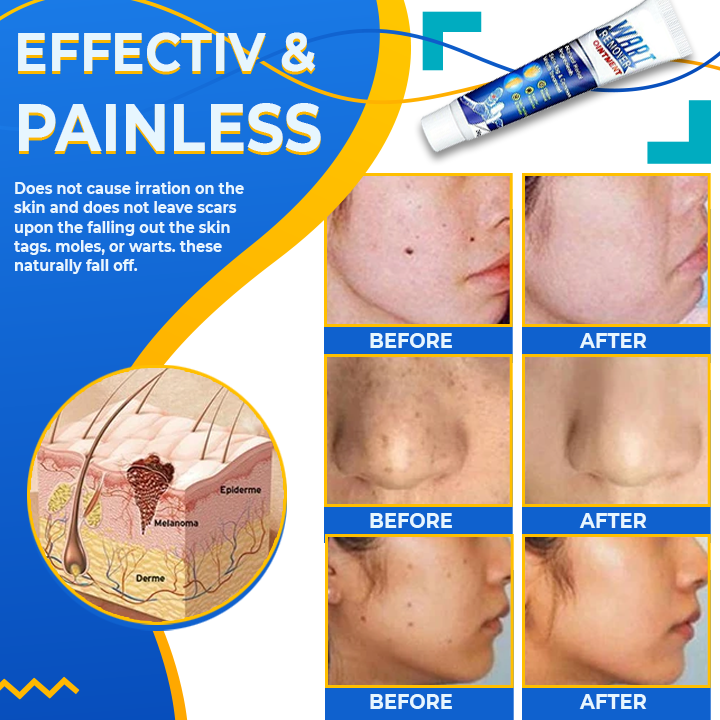 Sumifun™ Instant Wart Skin Corrector