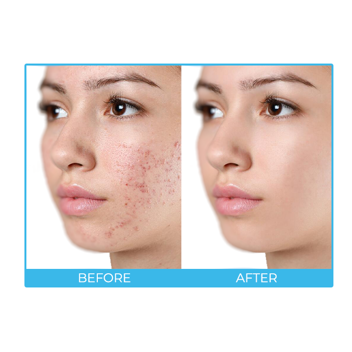 SkinAID™ Herbal Acne Removal Oil