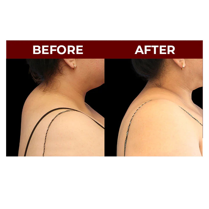 MEDix™ Neck Hump Swelling Cream