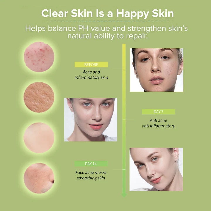 BioLap™ Aloe Vera Acne Serum Gel