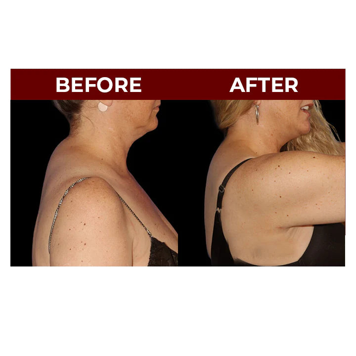 MEDix™ Neck Hump Swelling Cream