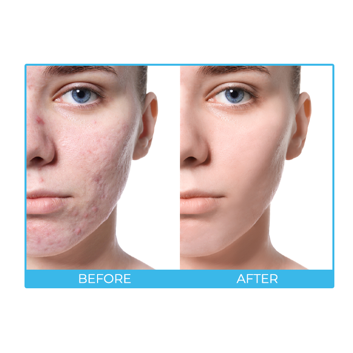 SkinAID™ Herbal Acne Removal Oil