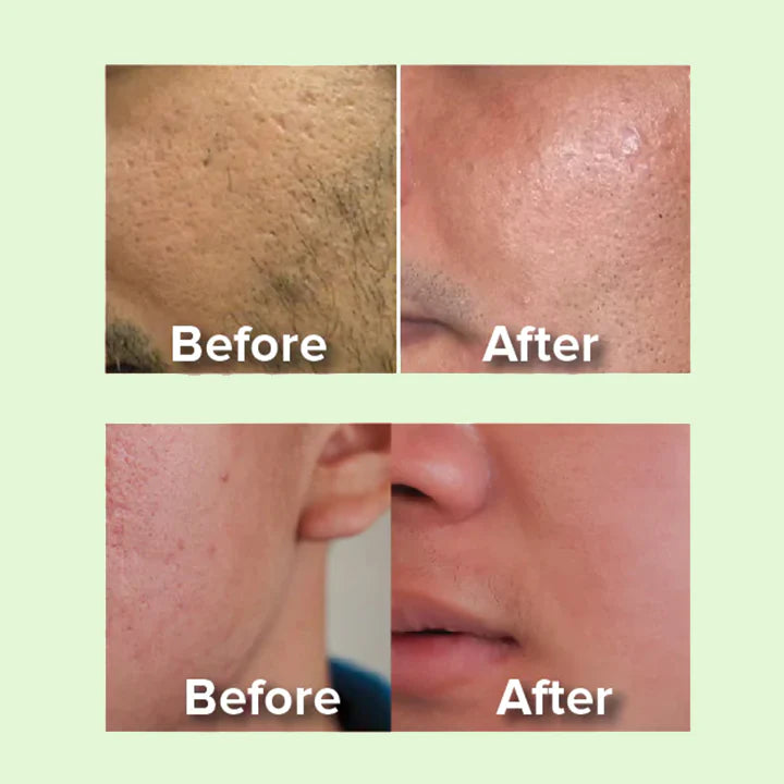 BioLap™ Aloe Vera Acne Serum Gel