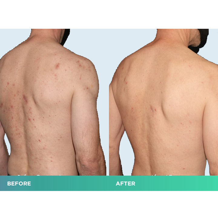 MEDix™ Back Acne Treatment Spray