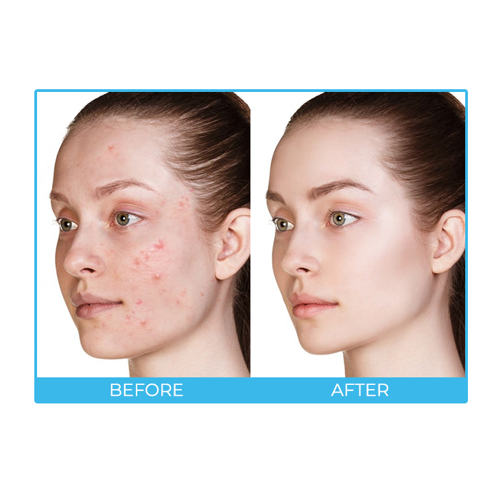 SkinAID™ Herbal Acne Removal Oil